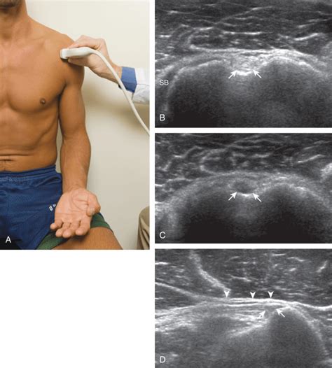 ultrasound of the shoulder ultrasound of the shoulder PDF