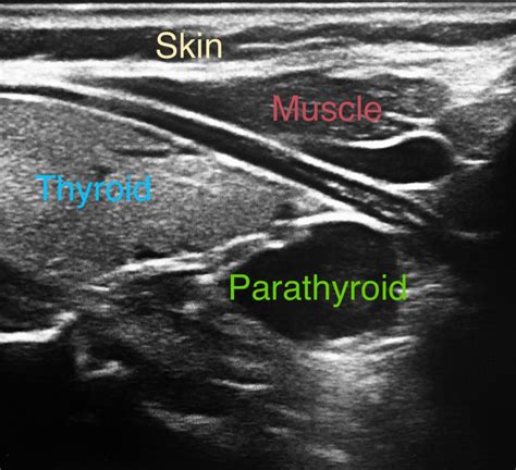 ultrasound of the thyroid and parathyroid glands ultrasound of the thyroid and parathyroid glands PDF