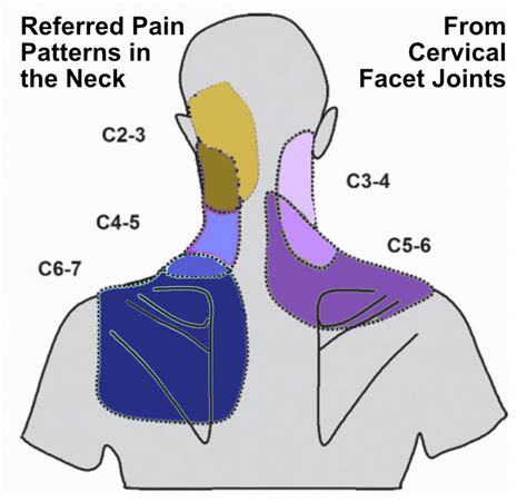 upper back neck pain functional patterns Reader