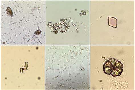 uric acid crystals in urine