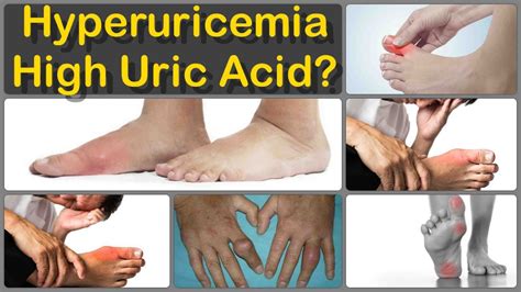 uric acid hyperuricemia gout naturopathic ebook Doc