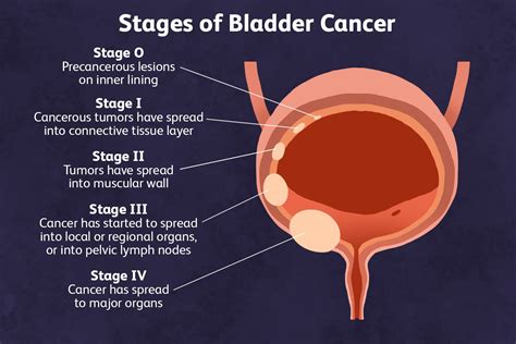 urinary bladder cancer prognosis