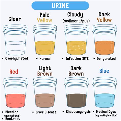 Uti Pee Color Chart
