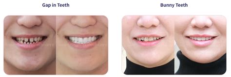 veneers cost singapore