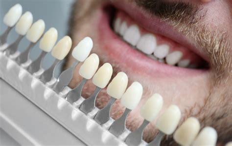 veneers singapore price