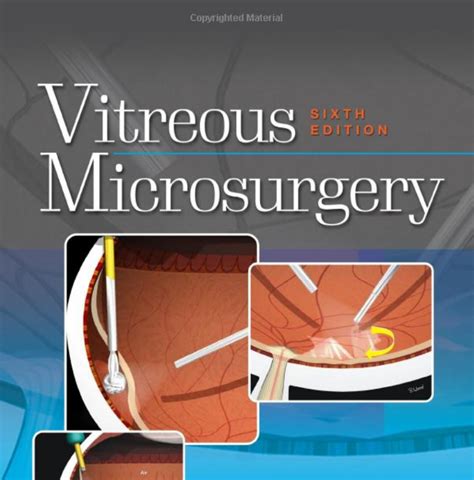 vitreous microsurgery Reader
