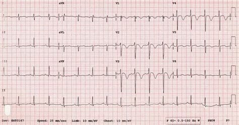 wallen ekg