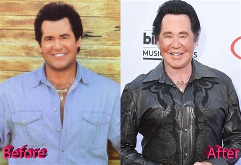 wayne newton plastic surgery