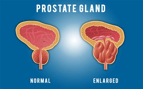 what is prostate gland in 17 weeks pregnancy PDF