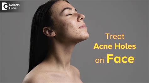 what is used to fill the holes on face due to acne and chickenpox PDF