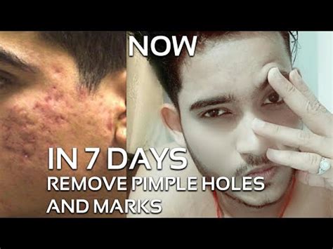 what is used to fill the holes on face due to acne and chickenpox PDF