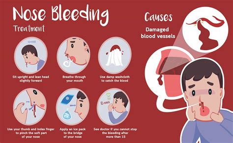 when to worry about a nosebleed