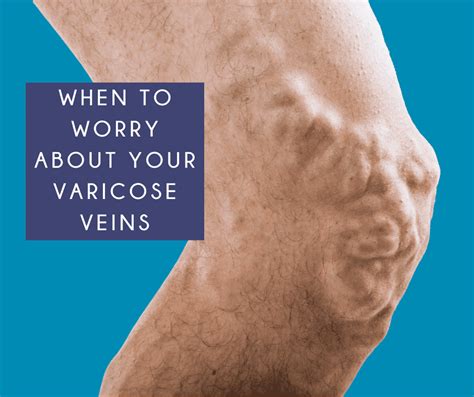 when to worry about varicose veins