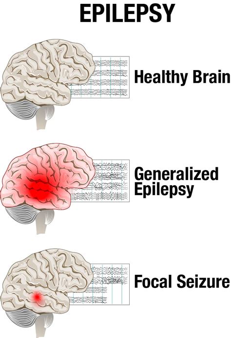 which type of seizure affects both sides of the brain