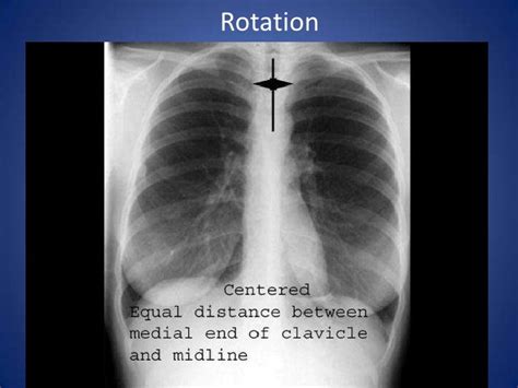 which way is a pt rotated cxr