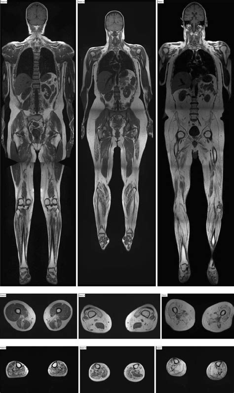 whole body mri scan