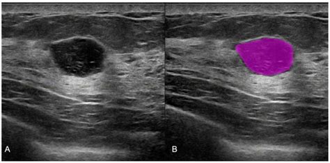 will an ultrasound show cancer